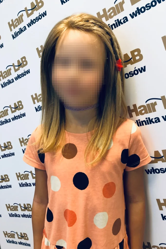 przyklad-uzupelnanie-wlosow-dla-dzieci-blur