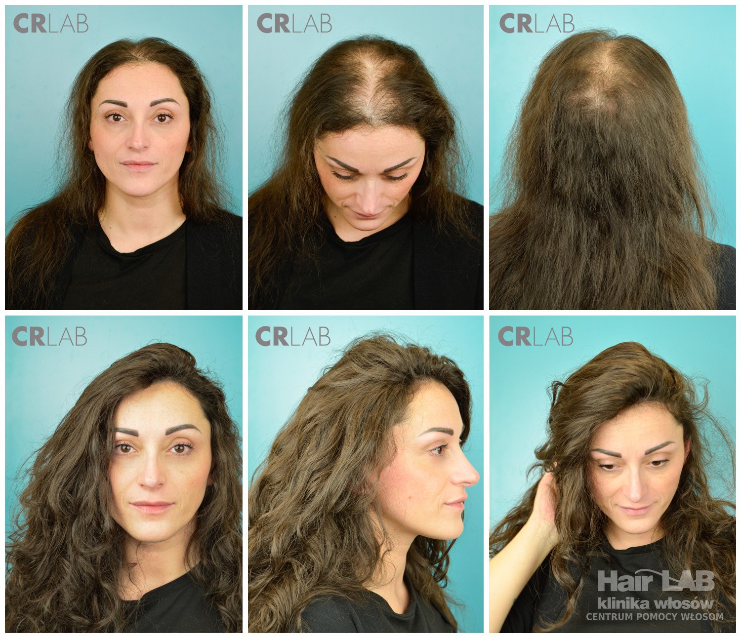 System niechirurgicznego uzupełniania włosów CNC Kobieta