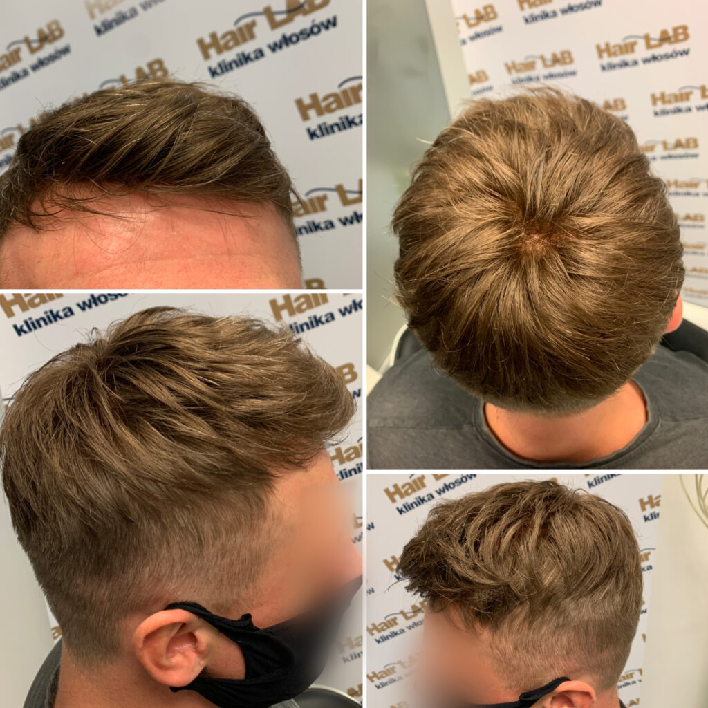 system-meski-uzupelnianie-wlosow