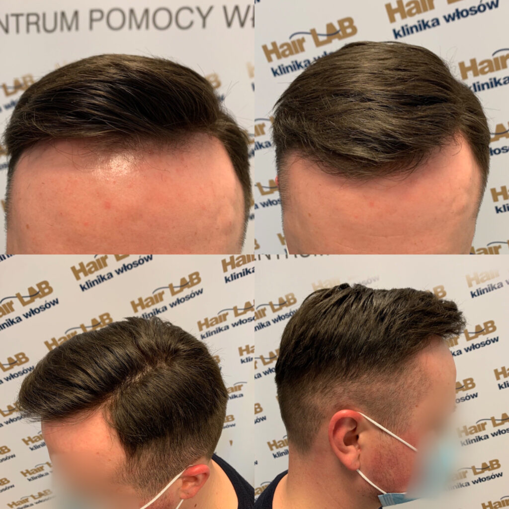 uzupelnianie-wlosow-meskie