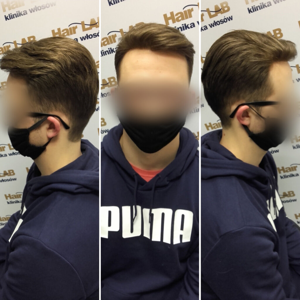 uzupelnianie-wlosow-mezczyzni